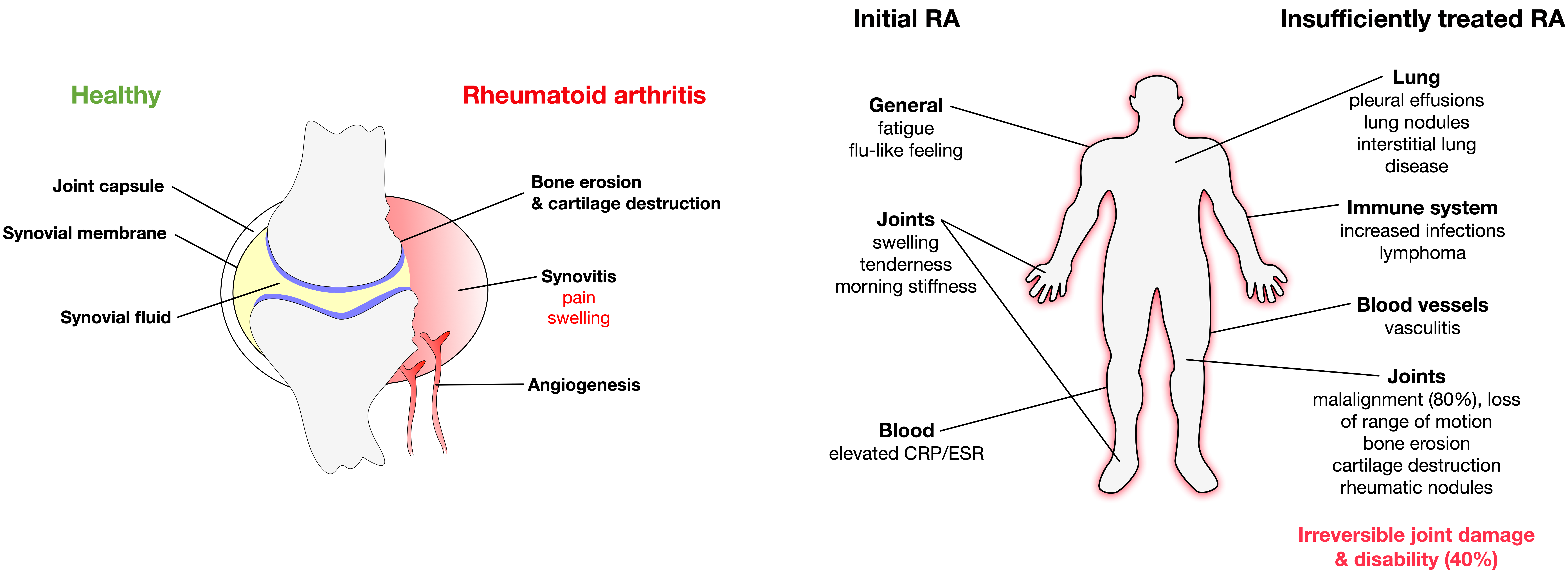 Rheumatoid Arthritis Encyclopedia MDPI