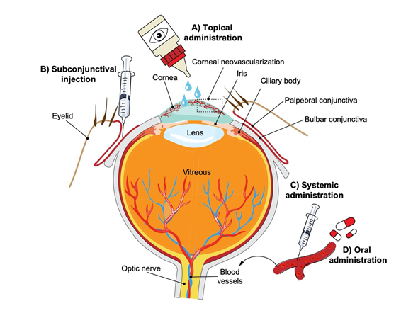 corneal vascularization riboflavin