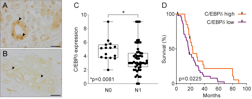 Figure 1: C/EBPδ in PDAC. (A) Normal pancreas duct cells express high levels of C/EBPδ protein. Scale bar is 20 µm.(B) C/EBPδ is lost in PDAC tissue samples. (C) C/EBPδ is significantly lower expressed in samples of patients with lymph node involvement than without. (D) High C/EBPδ-expression associates with improved survival in PDAC patients.