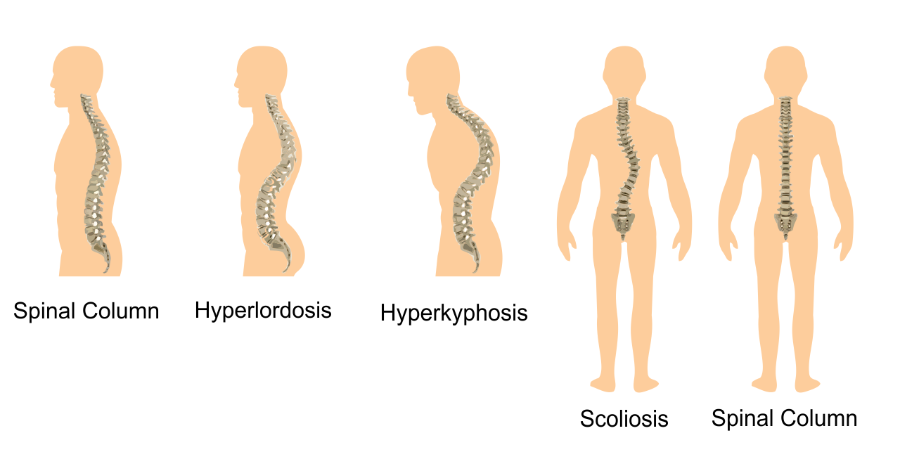 Postural deviations