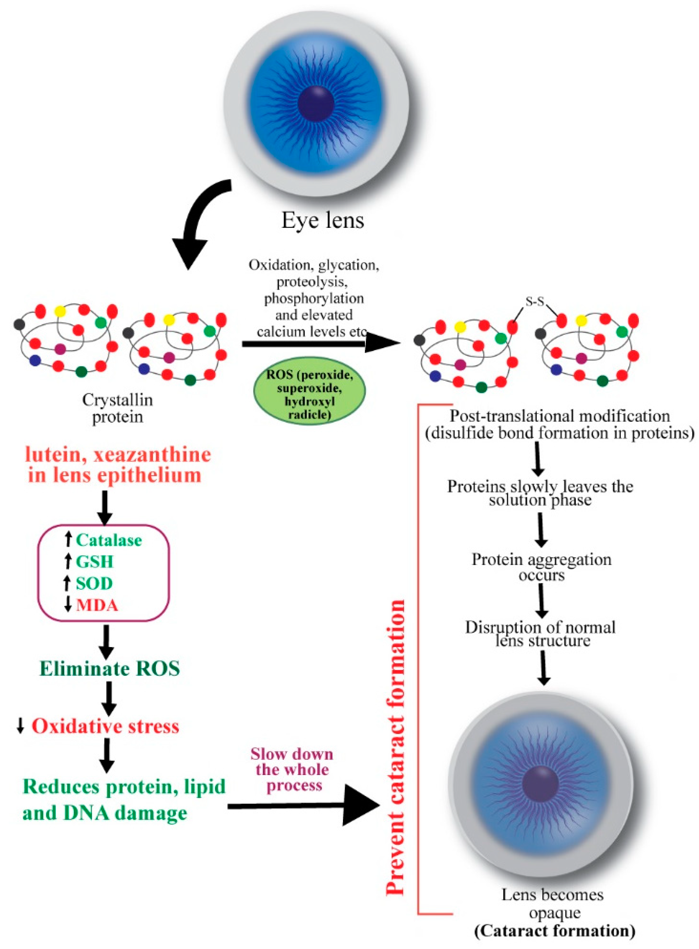 Senile Cataract Pathophysiology