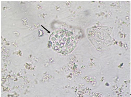 candida in urine