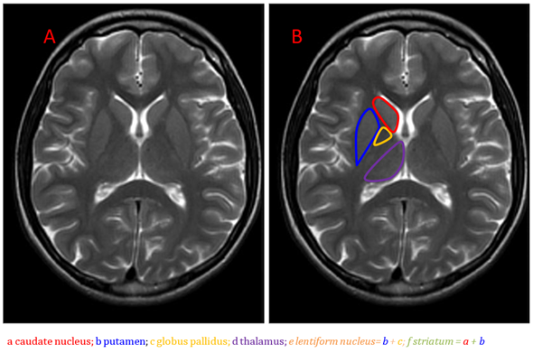 Basal Ganglia in Neurometabolic Diseases | Encyclopedia MDPI