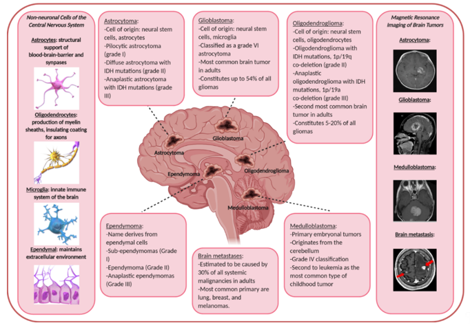 Most Common Primary Brain Tumor