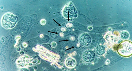 candida in urine